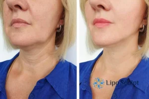 Double chin before and after Hi-Fu treatment 4 Book your double chin treatment Sonning today! We are here to help!