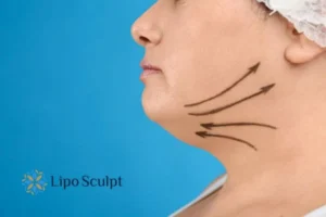 Double chin before and after Hi-Fu treatment 3 Boost your confidence with a Double chin treatment Sonning