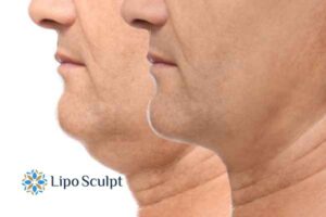 Double chin before and after Hi-Fu treatment 2 Double chin treatment Sonning from Lipo Sculpt - feel more confident today!