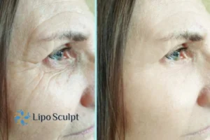 Do you want to Fight Aging Symptoms Sonning? Contact Lipo Sculpt today!