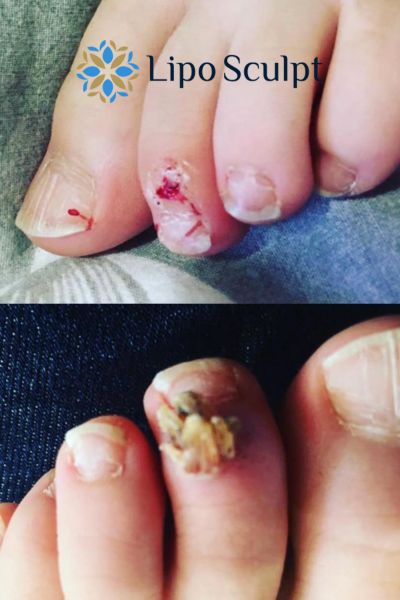 Wart removal customer results from Lipo Sculpt Sonning